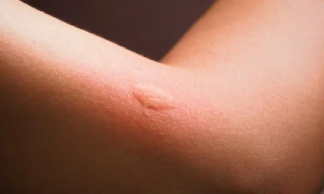 Gros plan sur un bras humain montrant une réaction cutanée rouge et enflée, typique d'une allergie ou d'un bouton de moustique.