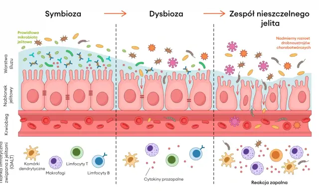 Ilustracja pokazuje, co to jest immunologia jelitowa: od symbiozy, przez dysbiozę, po zespół nieszczelnego jelita i reakcję zapalną.