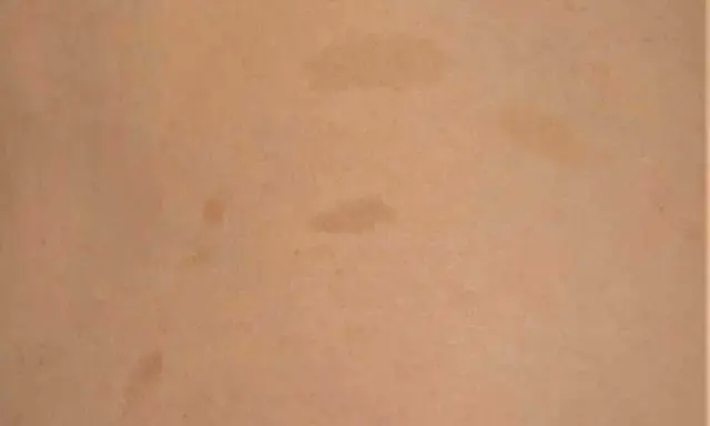 Macchie caffè latte sulla pelle, possibili indicatori di neurofibromatosi.