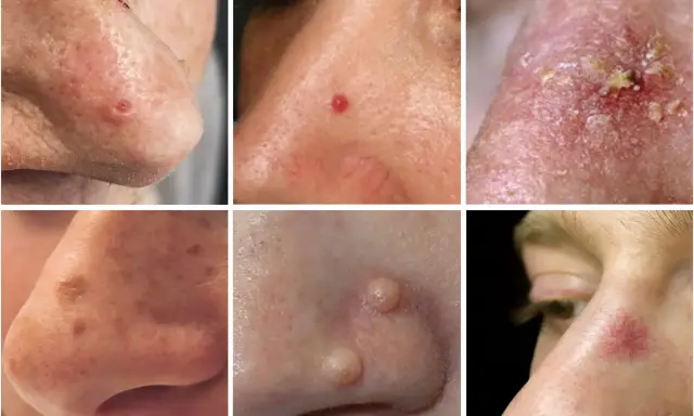 Six gros plans de nez montrant diverses affections cutanées : un bouton qui ne part pas, une rougeur, des croûtes, des taches, des excroissances et des vaisseaux sanguins dilatés.
