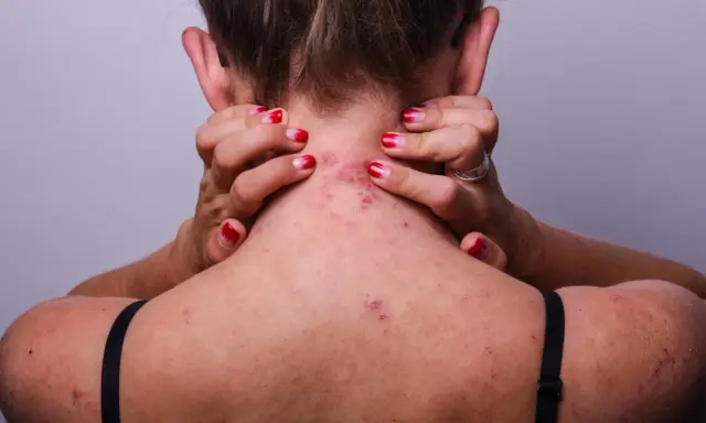 Vue arrière d'une personne se grattant le cou et le haut du dos, montrant des rougeurs et des irritations dues à l'eczéma.