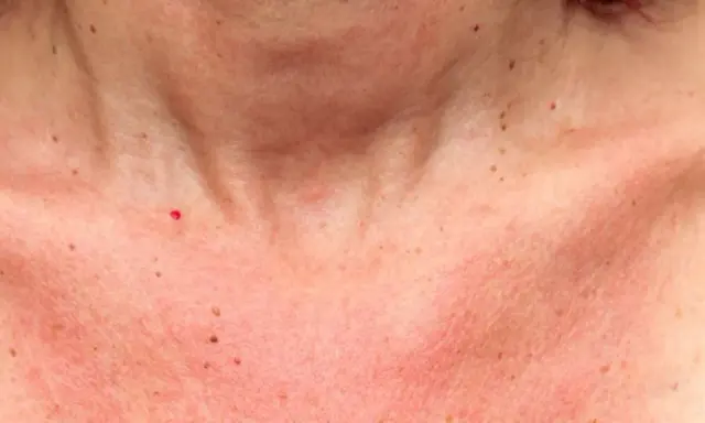 Peau rougie et tachetée sur le décolleté, avec une petite cicatrice soleil rouge vif.