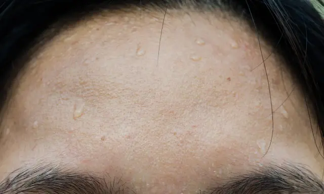 Gouttes de sueur sur le front, signe de transpiration excessive du visage après un effort.
