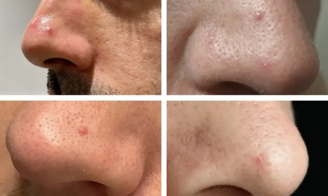 Gros plan sur le nez d'une personne, montrant des rougeurs et des petites lésions cutanées, possiblement un kyste sur le visage, nécessitant une attention médicale pour écarter tout risque de cancer.