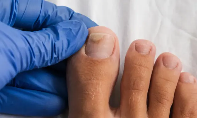 Main d'un podologue examinant un ongle de pied atteint de mycose. Renseignez-vous sur le tarif podologue mycose pour un traitement.