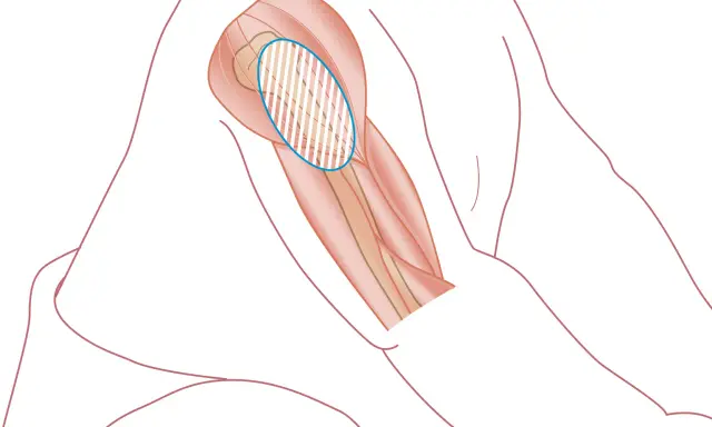 Illustration av en arm med markerad muskel där det kan kännas ont i armen efter tbe vaccination.