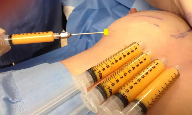 Lipofilling seno: pro e contro. Siringhe piene di grasso aspirato pronte per il rimodellamento del seno.