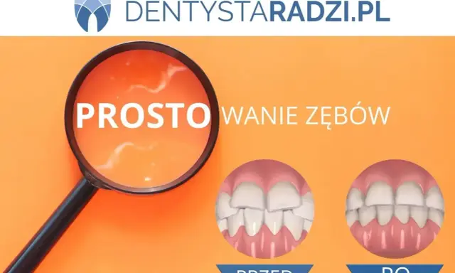 Proste licówki na krzywe zęby. Porównanie uśmiechu przed i po zabiegu.