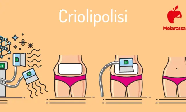Illustrazione della criolipolisi: il processo, i benefici e i possibili criolipolisi effetti collaterali.