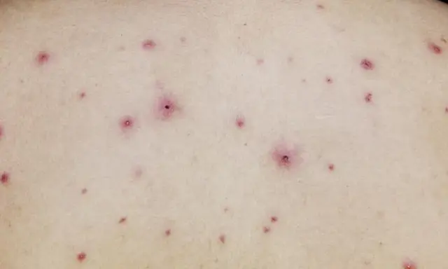 Skóra z licznymi, czerwonymi krostkami i grudkami. To mogą być ospa początki, zwiastujące chorobę.