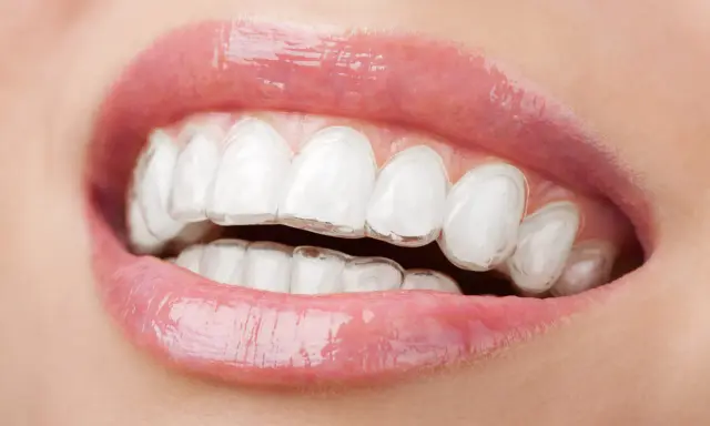 Zbliżenie na usta z widocznym aparatem Invisalign. Przezroczyste nakładki dyskretnie korygują zgryz, zapewniając piękny uśmiech.