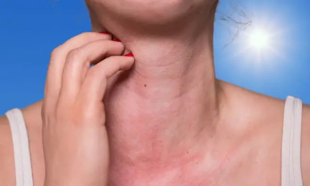 Une personne se gratte le cou rouge et irrité, peut-être à cause de boutons de soleil sur le visage et le corps. Le soleil brille intensément en arrière-plan.
