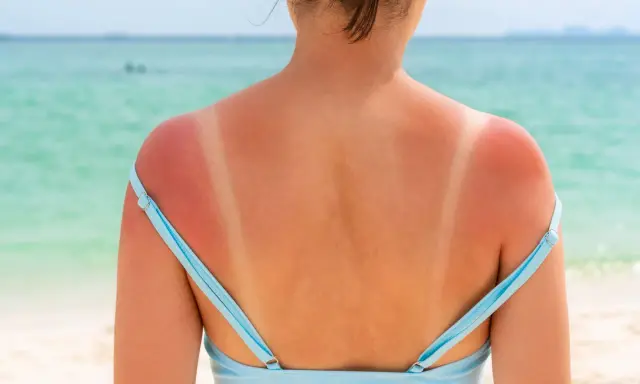 Spalle arrossate dal sole, con segni evidenti del costume. Una **pelle che non si abbronza** facilmente, ma che si scotta.