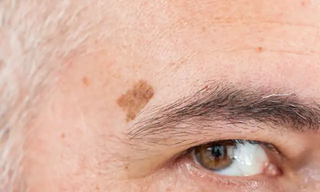 Gros plan sur le coin de l'œil d'une personne âgée, montrant des taches de vieillesse sur la peau et des sourcils poivre et sel.