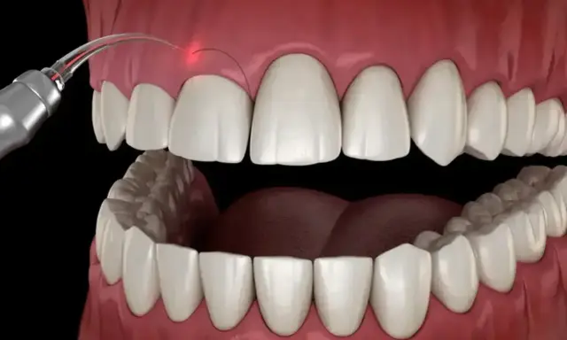 Zabieg gingiwektomii laserem: precyzyjne modelowanie dziąseł dla pięknego uśmiechu.