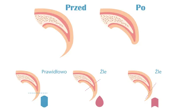 Ilustracja pokazuje przekrój pazura psa przed i po przycięciu. Pokazuje też prawidłowe i nieprawidłowe przycinanie, które może prowadzić do krwawienia.