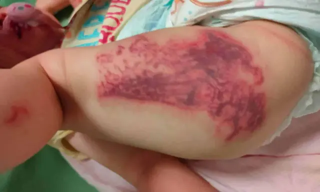Grossa macchia violacea sulla coscia di un neonato, simile a punture di medusa (quallenstich punkte).