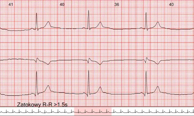EKG z zapisem rytmu zatokowego. Widoczne są fale serca z zaznaczonymi odstępami R-R >1.5s, wskazującymi na bradykardię.