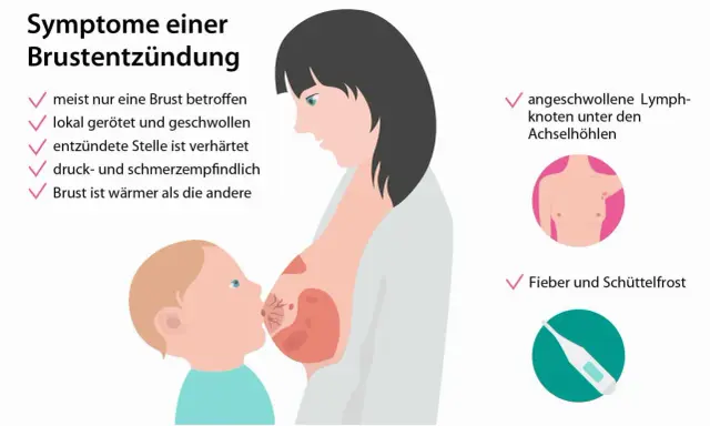 Brustentzündung: Rötung, Schwellung, Verhärtung, Schmerz, Wärme, Lymphknotenschwellung, Fieber. Dies sind häufige milchstau symptome.