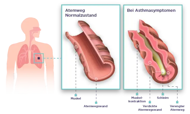 Vergleich von Atemwegen: Normalzustand vs. bei Asthmasymptomen. Bei unkontrolliertem Asthma verengen sich die Atemwege durch Muskelkontraktion und Schleimbildung.