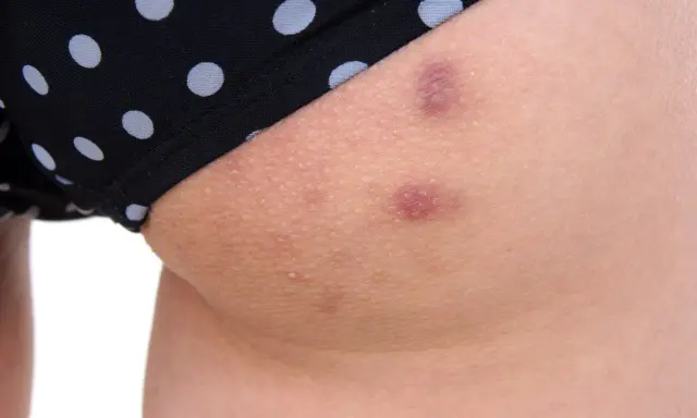 Krostki na pupie? Sprawdź, jak skutecznie odzyskać gładką skórę!