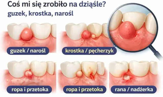 Ilustracja pokazuje różne zmiany na dziąśle: guzek, krostkę, ropę i ranę. Bąbel na dziąśle może mieć różne formy.