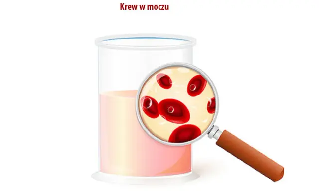 Szklanka z płynem i szkło powiększające ukazujące czerwone krwinki. Obrazek ilustruje bezbolesny krwiomocz.