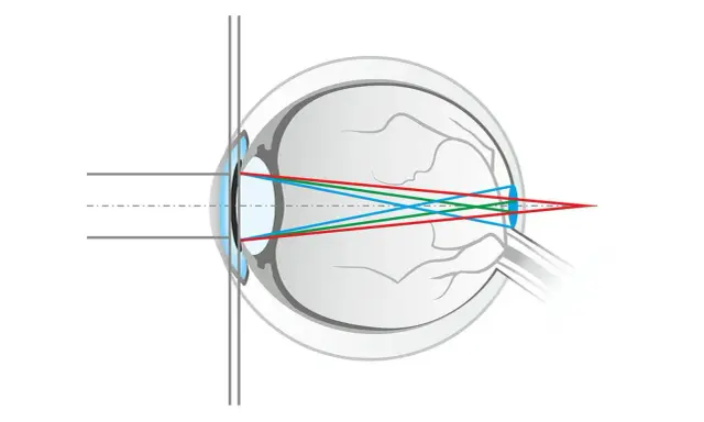 Schéma de l'œil montrant la réfraction des rayons lumineux rouge, vert et bleu. La lumière bleue est plus déviée, illustrant qu'est ce que la lumière bleue.