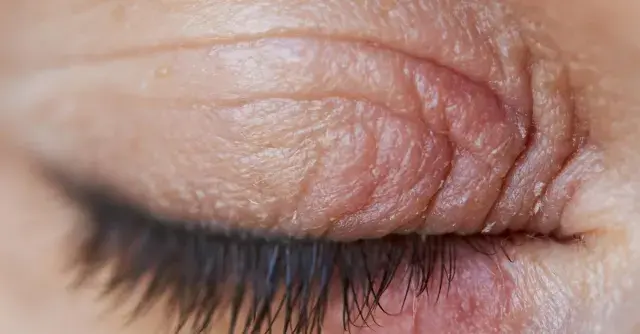 Gros plan sur un œil fermé, montrant la peau irritée et squameuse typique de l'eczéma paupière.