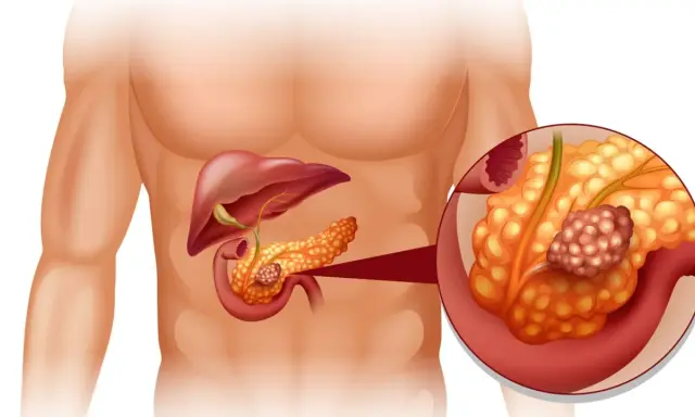 Ilustracja anatomiczna przedstawiająca trzustkę z guzem nowotworowym.