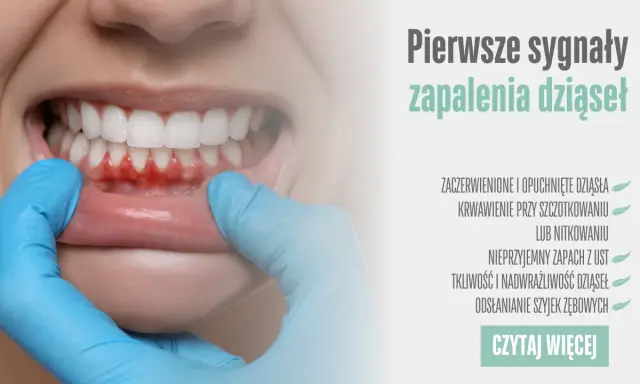 Zapalenie dziąseł: 7 objawów, których nie wolno ignorować!