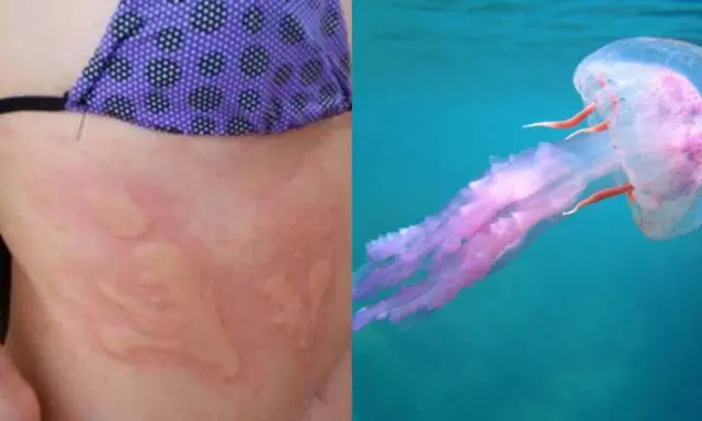 Pelle arrossata con segni di una **piqûre meduse** e una medusa rosa trasparente che nuota nell'acqua blu.