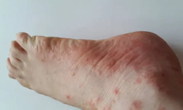 Pieds présentant des rougeurs et des petits boutons qui grattent, signe d'une irritation cutanée.