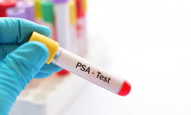 Ręka w niebieskiej rękawiczce trzyma probówkę z napisem "PSA - Test". To kluczowy krok w diagnostyce, który może pomóc w zrozumieniu, jak obniżyć psa prostaty.