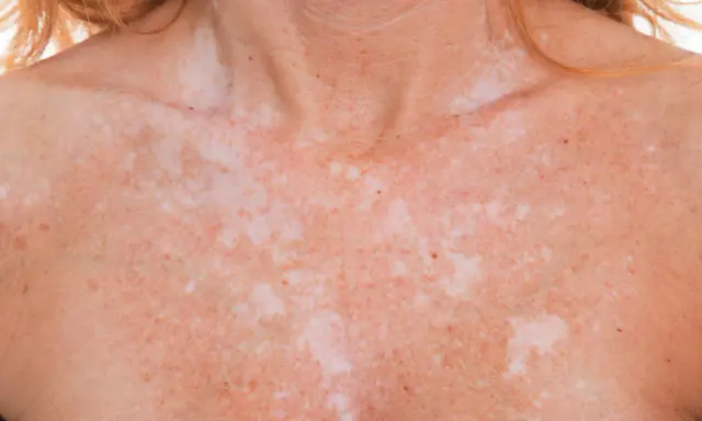 Poitrine et cou d'une personne avec une peau tachetée, montrant des zones de pigmentation inégale dues à l'exposition au soleil.