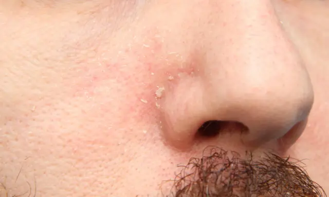 Pelle arrossata e desquamata intorno al naso, sintomo di dermatite seborroica.