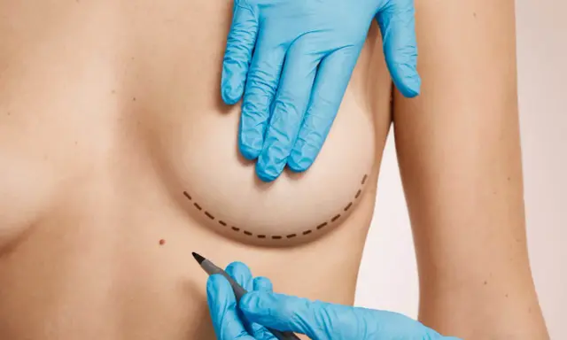 Mani guantate disegnano il contorno per una mastoplastica additiva, segnando il percorso per un futuro miglioramento.