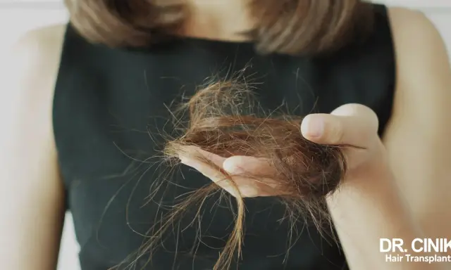 Une femme de 40 ans examine une poignée de cheveux tombés, signe de perte de cheveux.