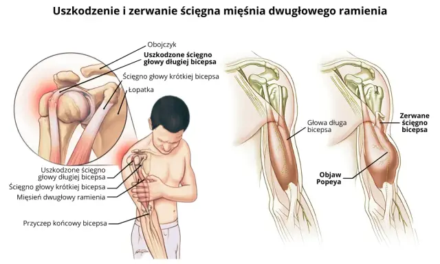 Ilustracja pokazuje uszkodzenie i zerwanie ścięgna bicepsa, powodujące ból bicepsa i objaw Popeya.