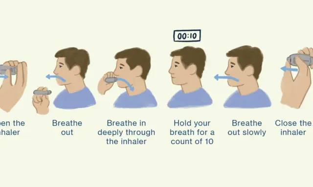Schritt-für-Schritt-Anleitung zur Pulmicort Anwendung: Inhalator öffnen, ausatmen, tief inhalieren, 10 Sekunden Luft anhalten, langsam ausatmen, Inhalator schließen.