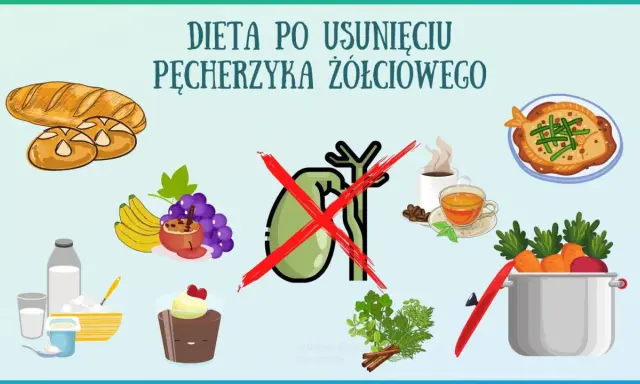 Zdrowe jedzenie po usunięciu woreczka żółciowego: pieczywo, owoce, nabiał, ryba, warzywa. Unikaj kawy i słodkości.