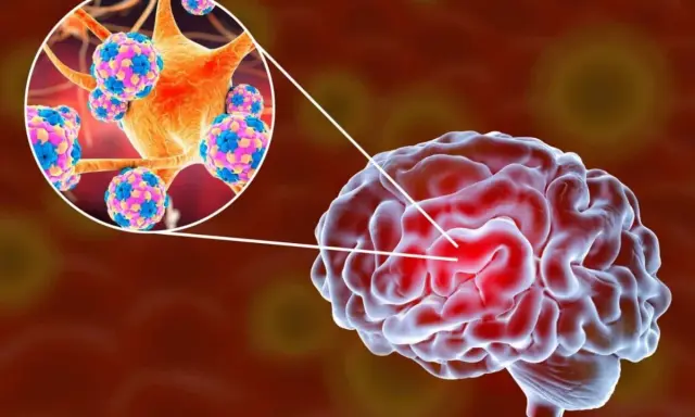 Illustration av hjärnan med en förstorad vy av virus som orsakar hjärnhinneinflammation.