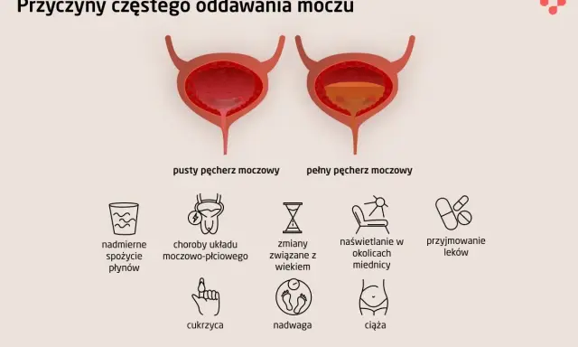 Ilustracja przedstawia przyczyny częstego oddawania moczu w dużych ilościach: nadmierne picie, choroby układu moczowo-płciowego, wiek, naświetlanie, leki, cukrzyca, nadwaga, ciąża.