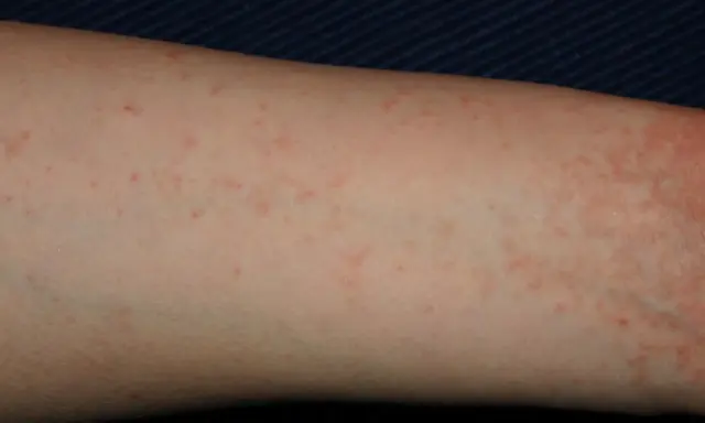 Braccio con piccoli puntini rossi, un segno di inizio scabbia. La pelle appare leggermente irritata.