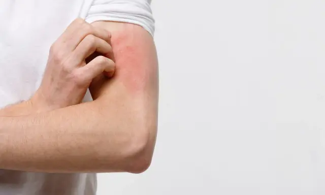 Braccio con arrossamento e prurito, possibile eczema diabetico.