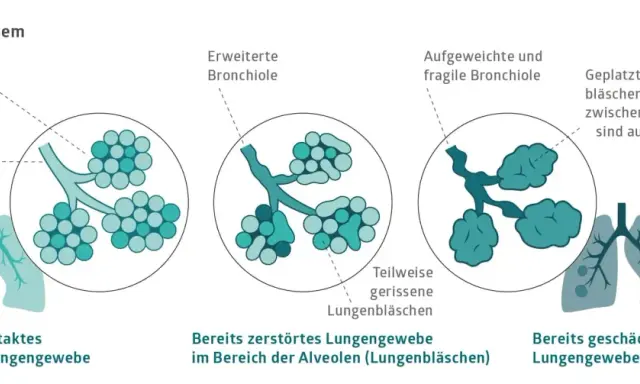 Veranschaulicht die Zerstörung von Lungenbläschen bei COPD, auch ohne Rauchen. Zeigt gesunde, erweiterte und geplatzte Lungenbläschen.