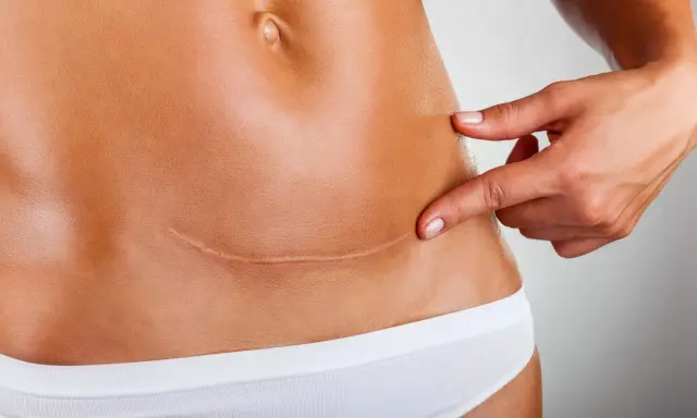 Ból po cc? Dłoń wskazuje na bliznę po cesarskim cięciu, gdzie może rozwijać się endometrioza.