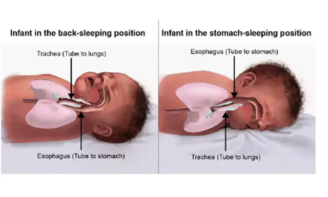Illustrazione anatomica che mostra come far addormentare un neonato in posizione supina, con trachea e esofago liberi.