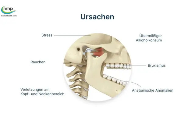 Das Bild zeigt Ursachen für Kiefergelenksprobleme, darunter Stress, übermäßigen Alkoholkonsum, Bruxismus, Verletzungen und Rauchen, das zu Verspannungen führen kann.