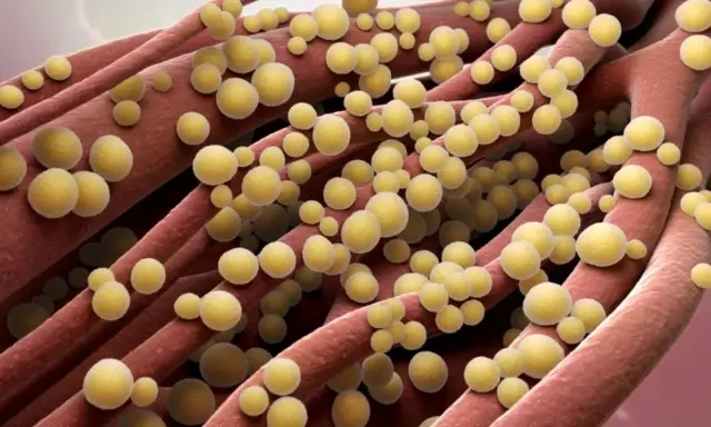 Ingrandimento di fibre rosse con batteri sferici gialli, possibile infezione naso stafilococco.
